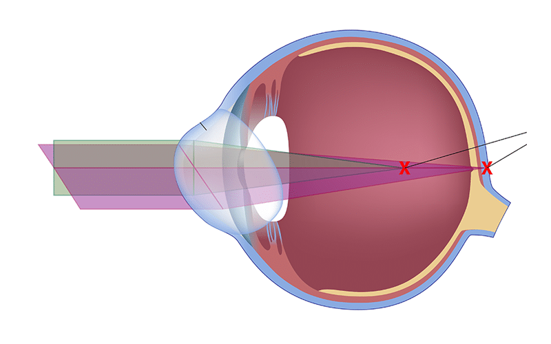 Bild för artikel: Kan ögonlaser behandla astigmatism?