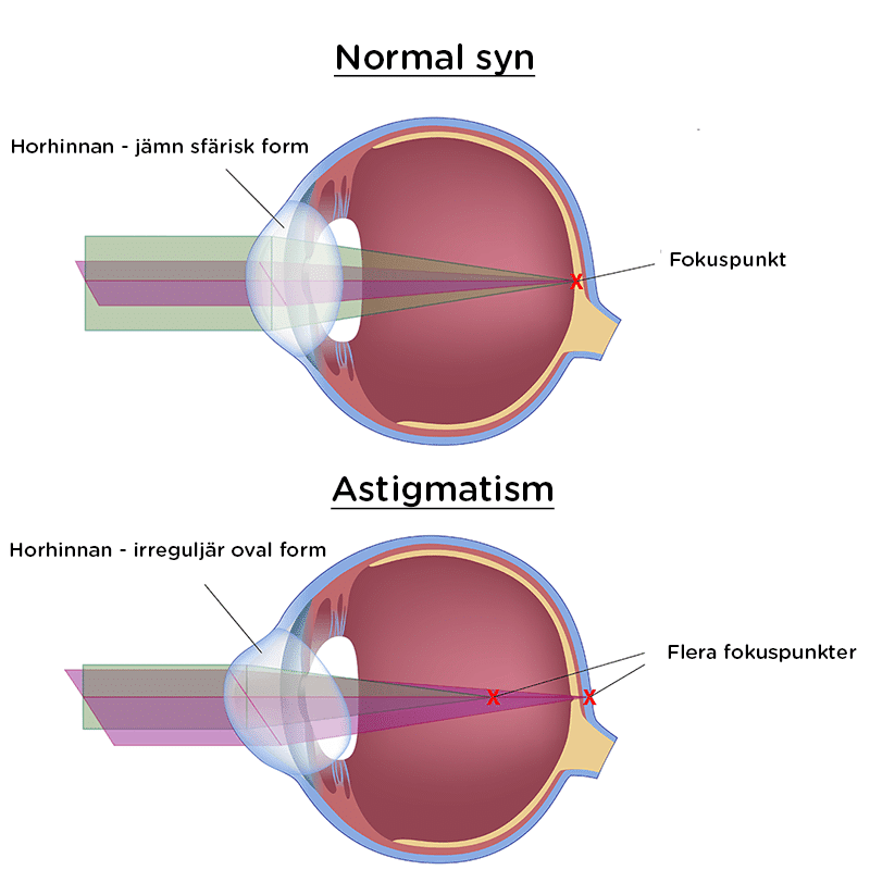 Kan ögonlaser behandla astigmatism?
