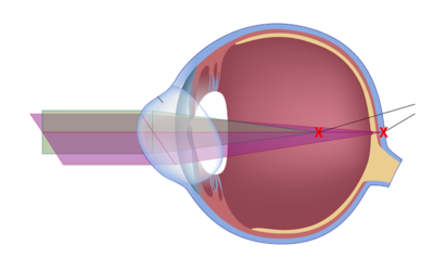 Ögonlaser astigmatism
